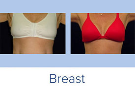 Breast Augmentation Surgery