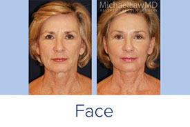 facial plastic surgery