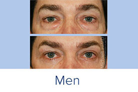 plastic surgery for men